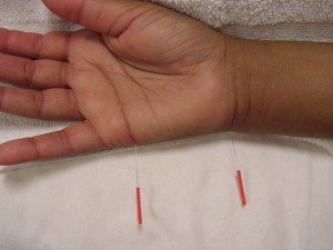 acupuncture-at-mskcc